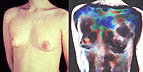 [liquid crystal thermography of human chest]